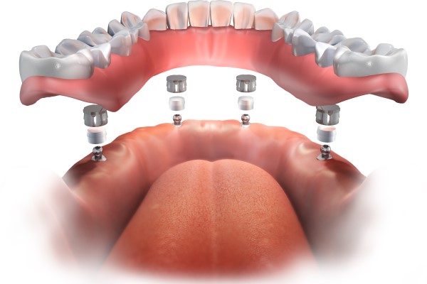 All On 4 Dental Implants North Mankato, MN