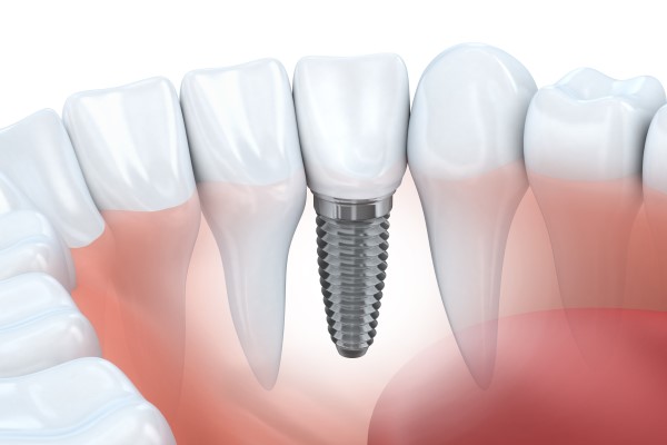 Three Benefits Of Dental Implants