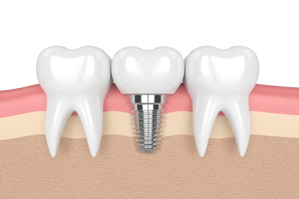 Consider Dental Implants For Replacing A Missing Tooth
