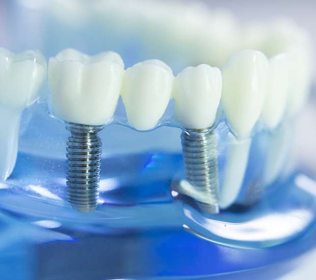 North Mankato Dental Implants