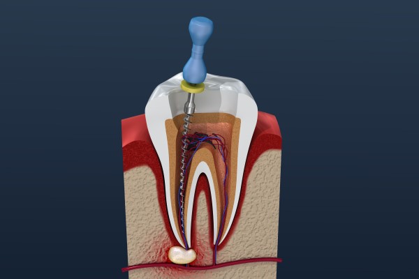 Root Canal Treatment North Mankato, MN