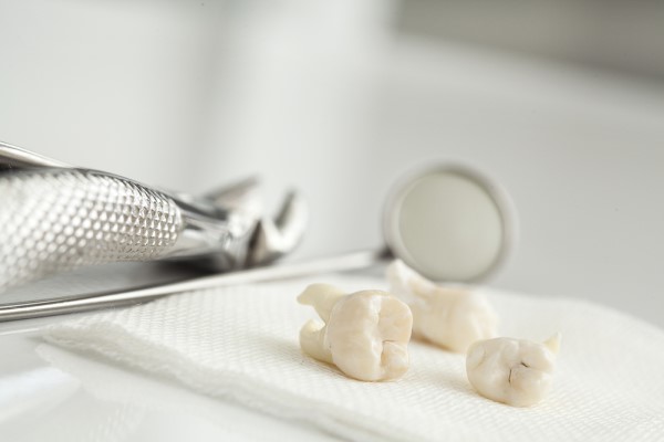 How To Know Whether To Have Wisdom Teeth Removed